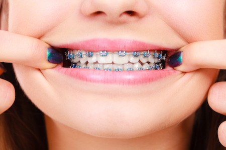orthodontist braces blue