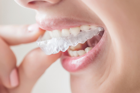 Types of Braces, Upper St Clair, South Hills, Bethel Park